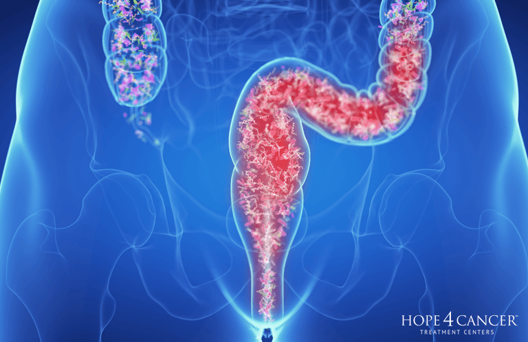 Gastrointestinal Cancers and the Microbiome: A Close Link